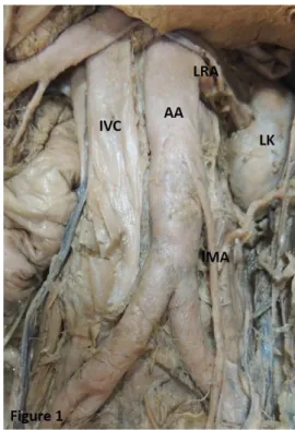 Figure 1. Showing absence of the testicular artery. AA: abdominal  aorta; IMA: inferior mesenteric artery; IVC: inferior vena cava; 