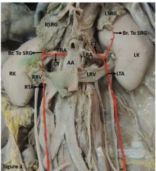 Figure 3. Showing a common arterial trunk (CT) arising from  the renal artery (LRA) and abdominal aorta (AA) on the left  and right sides respectively