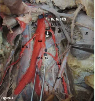 Figure 6. Showing duplication in branching of the left testicular  artery (LTA) (Indicated by*)
