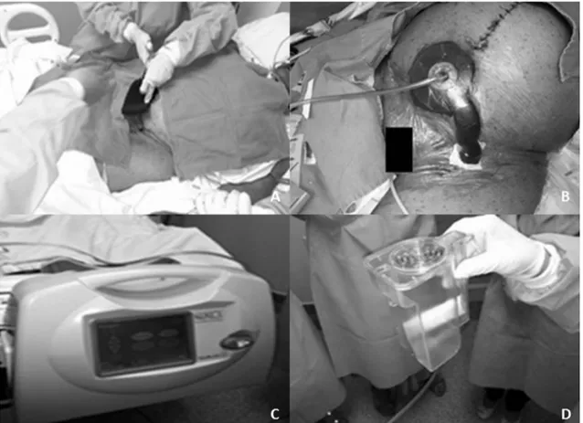 Figura 1. Aplicação do curativo a vácuo após o desbridamento das incisões deiscentes. (A) Troca do curativo com a colocação da  esponja de poliuretano no leito das feridas; (B) Kit de sucção e ilme plástico devidamente instalados; (C) Equipamento de pressã