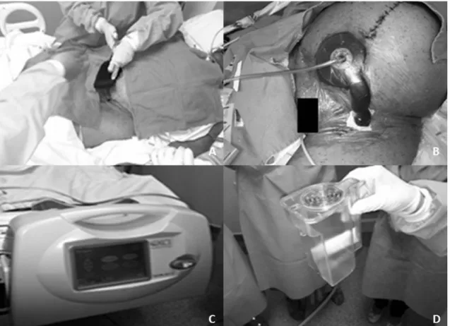 Figure 1. Application of vacuum dressing after debridement of dehiscent incisions. (A) Dressing change, placing polyurethane foam  on wound beds; (B) Suction kit and plastic ilm correctly itted; (C) Negative pressure unit attched to patient’s bed; (D) Repl