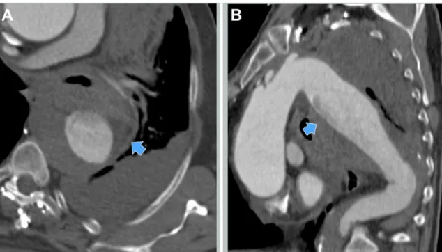 Figure 3. Intraoperative aortography with evidence of the  descending thoracic aortic aneurysm (arrow).