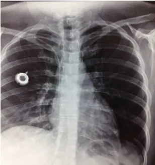 Figure 2. Catheter detached from the reservoir implanted in  the right thorax.