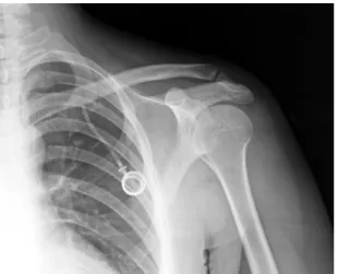 Figure 5. X-ray showing the reservoir and part of the catheter  implanted in the left thorax.