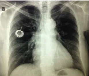 Figure 6. Chest X-ray showing the fragmented catheter and the  reservoir in the right thorax.