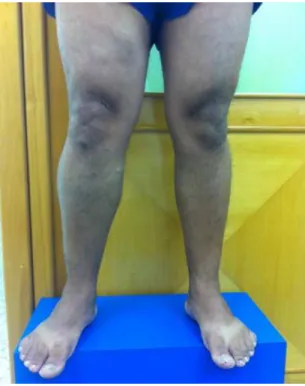 Figure 2. Lower limbs with patient standing upright, front view,  showing asymmetry of right lower limb.