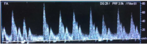 Figure 1. Atrial ibrillation.