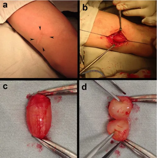 Figure 1. Images showing the preoperative appearance (a); the cystic lesion dissected and irmly adhering to the basilic vein, which  was repaired with cotton thread (b); the resected lesion (c); and the lesion sectioned, showing its content (d).