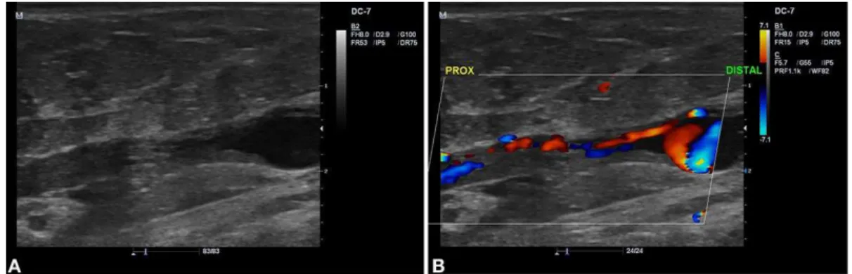 Figure 1. Sonographic images showing recanalization of a mid-distal segment of the lateral accessory saphenous vein (LASV)