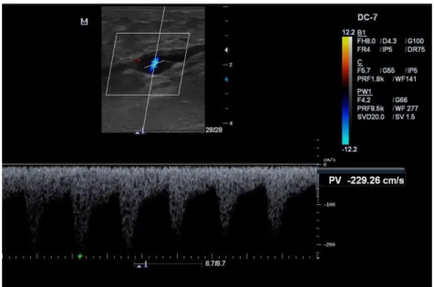 Figure 2. Sonographic image of the mid-distal segment of the lateral accessory saphenous vein (LASV) showing low resistance  pulsating low, with continuous ascending low and no interference from respiratory rhythm or response to the Valsalva maneuver  or d