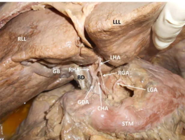 Figure 2. Photograph showing the variant branching pattern of  upper abdominal vessels