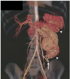 Figure 1. Reconstruction from the computed tomography executed  for planning of endovascular treatment