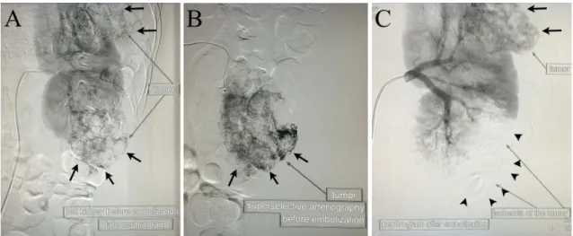 Figure 2. (A) Selective arteriography of the kidney prior to embolization; the arrows indicate the target tumors for embolization
