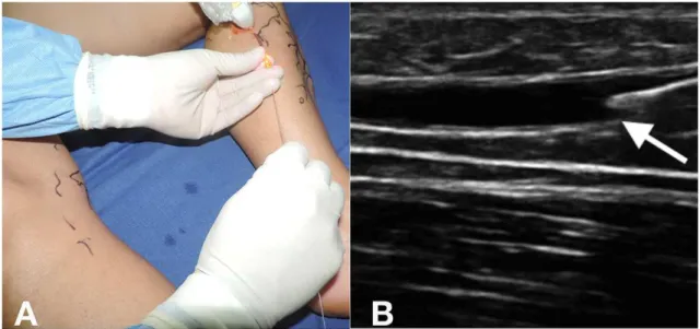 Figure 1. Ultrasound-guided puncture (A) and placement of bare iber (B).