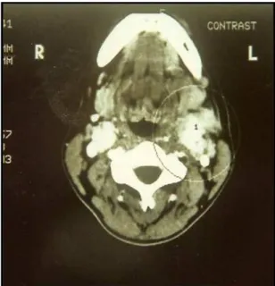 Figure 2. Tomographic image showing evidence of the presence  of bilateral tumors at the level of the carotid bifurcations.