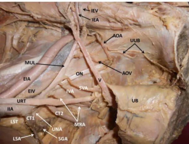 Figure 1. Dissection of the left half of the pelvis showing variant  branches of the internal iliac artery