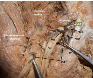 Figure 3. Schematic diagram of variant branches of the internal  iliac artery. IIA: Internal Iliac Artery; CT1: Common Trunk 1; 
