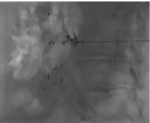 Figure 3. Embolization of type II endoleak via translumbar  access. Calculating trajectory with three-dimensional computed  tomography in real time