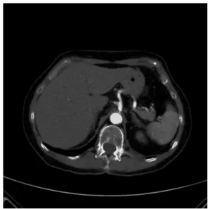 Figure 1. Difuse aortic atherosclerotic disease with near-occlusion  of the celiac trunk.