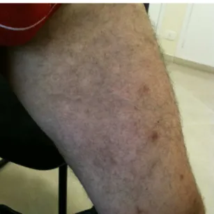 Figure 3. Postoperative result of embolization of the venous  malformation.