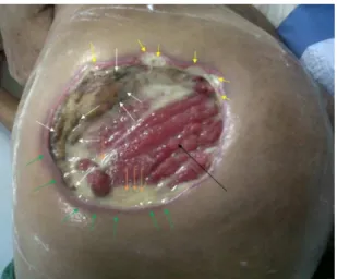 Figure 1. Gluteus maximus muscle (black arrow), ischemic process  (yellow arrow), necrotic borders (white arrow), and exudate  (orange arrow)