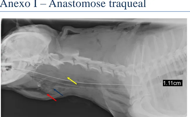 Figura 1 – Radiografia cervical, em projecção latero-lateral, com evidência de enfisema peritraqueal (seta  amarela), enfisema subcutâneo (seta vermelha) e descontinuidade da traqueia cervical (seta azul)