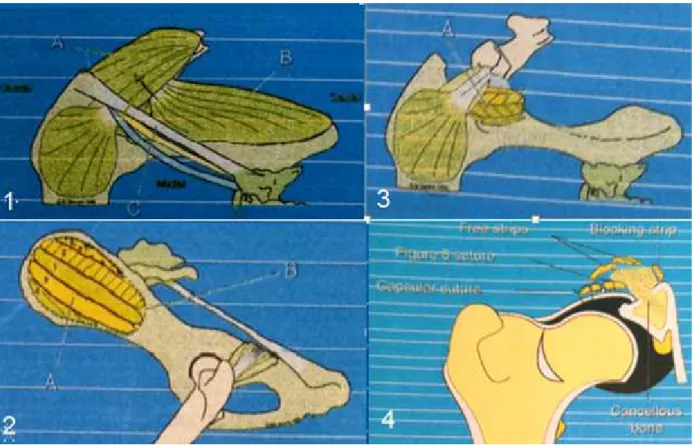 Figura 2: Técnica da Plastia do Bordo Acetabular Dorsal. 1- Acesso à capsula articular pelo afastamento do músculo  bíceps femoral (A) caudalmente (sentido da seta verde) e do músculo glúteo superficial (B) cranealmente