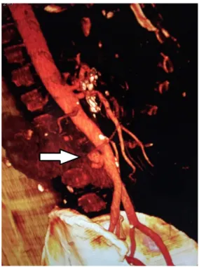 Figure 1. Angiotomography of the abdominal aorta, showing  a pseudoaneurysm of the posterior wall.