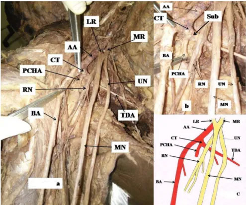 Figure 1. (a) showing a common trunk from the third part of the axillary artery and abnormal positions of the radial nerve and median  nerve; (b) enlarged view; (c) schematic diagram showing variations of the third part of the axillary artery and abnormal 