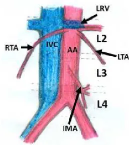 Figure 1. Schematic diagram showing the normal right and left  testicular artery (RTA &amp; LTA) originating from the abdominal  aorta (AA) at the level of the second lumbar vertebra, just below  the renal vessels