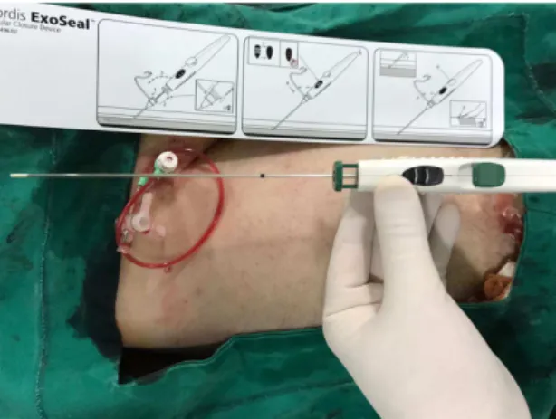Figure 1. Vascular closure device.