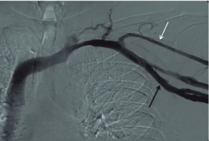 Figure 7. Path of catheter incorrectly positioned in the internal  jugular vein.