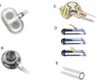 Figure 1. Types of totally implantable catheter (ports). (A) Double-chamber plastic port; (B) Single metal port; (C) Valve located  in port; (D) Valve at end of closed-tip catheter
