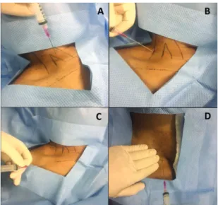 Figure 2. Deep vein puncture techniques most commonly  used for insertion of venous catheters