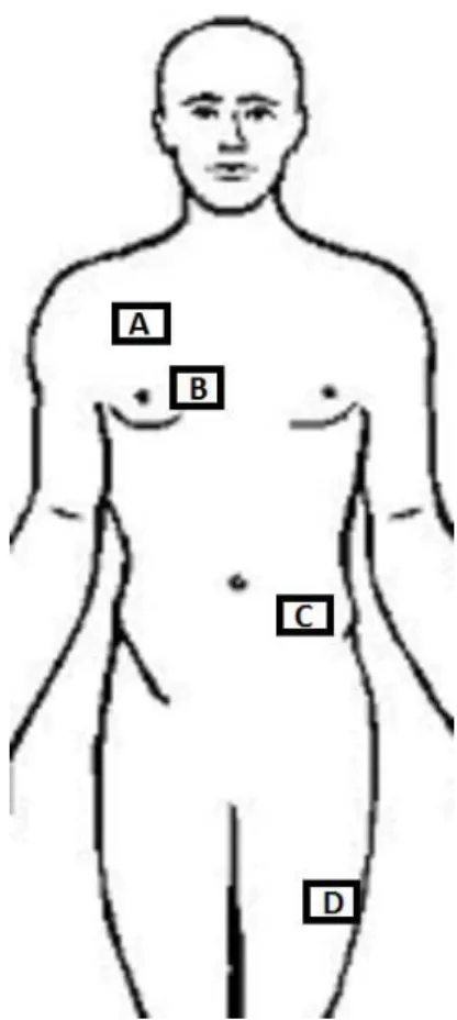 Figure 5. Most frequent sites for placement of the port. When  veins that drain to the superior cava system are chosen, the port  can be itted in an infraclavicular (A) or parasternal (B) position