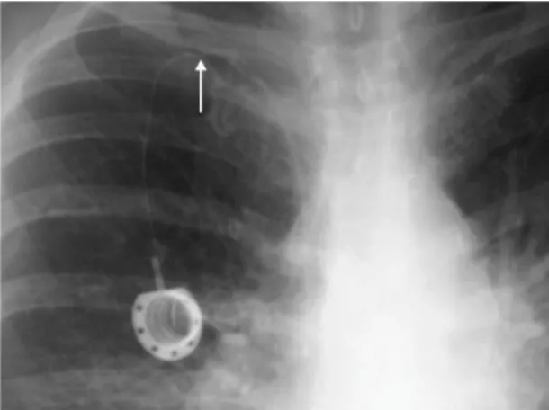 Figure 6. Constriction of the catheter (arrow) in the space  between the clavicle and the irst rib.