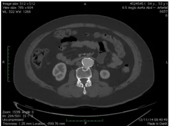 Figura 1. Corte axial de angiotomograia pré-operatória mostrando o aneurisma de aorta com erosão da vértebra lombar.