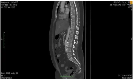 Figura 2. Corte sagital de angiotomograia pré-operatória mostrando o aneurisma de aorta com erosão da vértebra lombar.