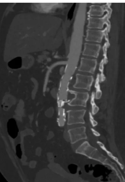Figura 5. Reconstrução 3-D em software Osirix   mostrando a  endoprótese monoilíaca e o enxerto fêmoro-femoral cruzado  pérvio e sem evidência de pseudoaneurismas.