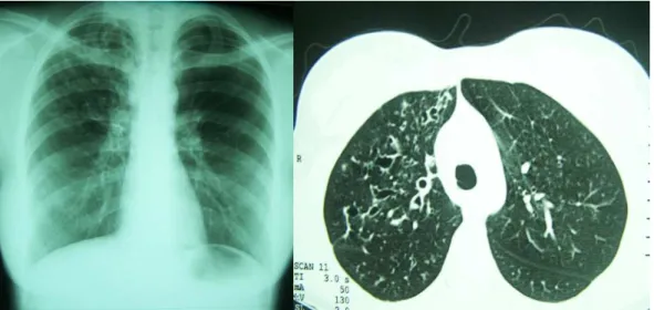 Figura  2  -  Radiografia  evidenciando  acentuação  das  imagens  brônquicas  (opacidades lineares no escore de Brasfield) e pelo menos uma lesão cística  sugestiva de bronquiectasia