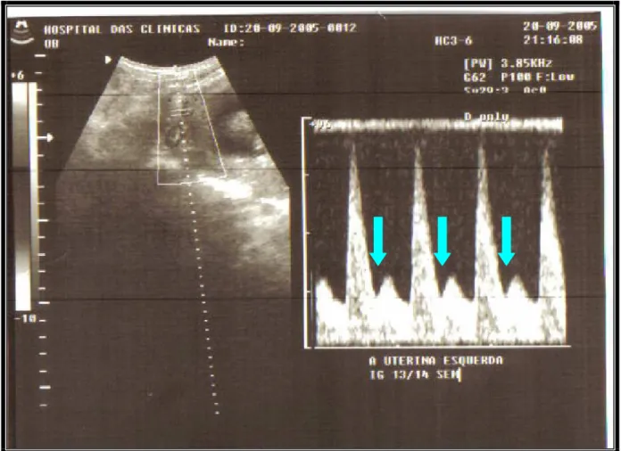 Figura 5 – Dopplerfluxometria da artéria uterina materna com incisura protodiastólica