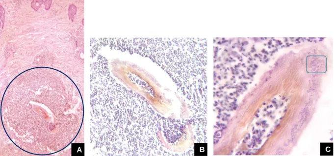 Fig. 3 -  Imagens do exame histopatológico (biópsia):  