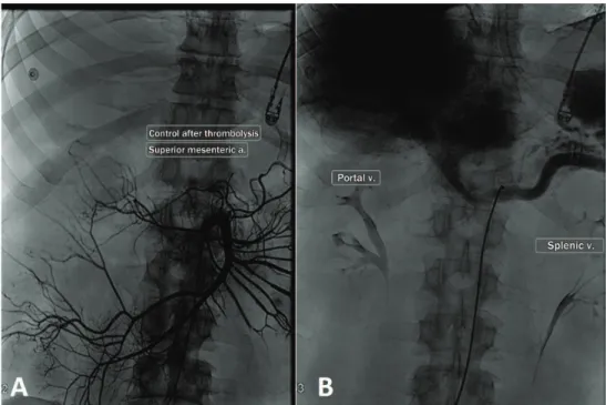 Figure 3. Control splenoportography after thrombolysis by superior mesenteric artery catheterization (3A), showing patent portal  vein (left) and splenic vein (right) (3B).