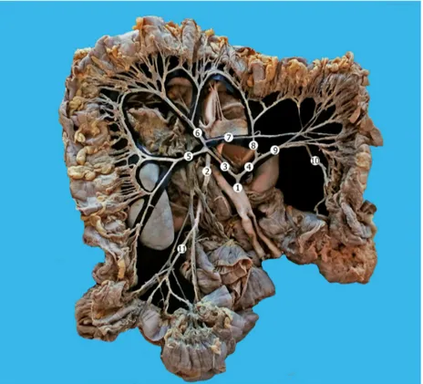 Figure 1. Vascularization of the large intestine. Macro specimen (female, 61 years). 1) inferior mesenteric artery; 2) superior mesenteric  artery; 3) common trunk of the right colic and middle colic arteries; 4) common trunk of the accessory middle colic 