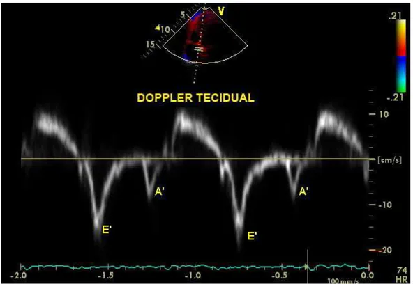 FIGURA 2: Doppler tecidual pulsátil ao nível da porção basal do septo  interventricular