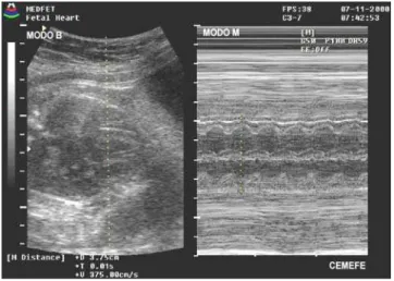 Figura 1 – Imagem ecográfica das quatro câmaras do coração fetal com determinação  da medida do DBVE