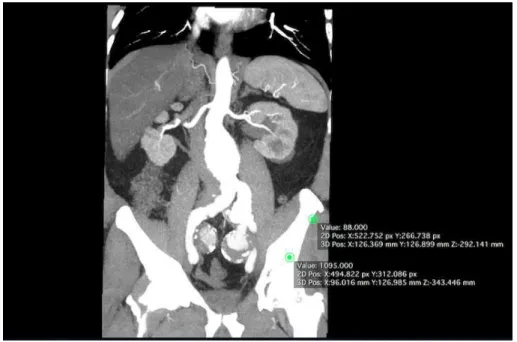 Figura 1. Angiotomograia pré-operatória em corte coronal.