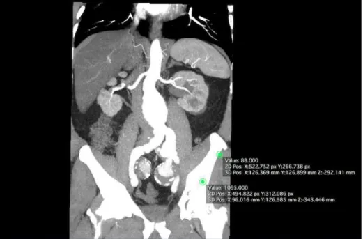 Figure 1. Coronal preoperative angiotomography.