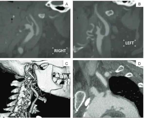 Figure 1. Preoperative angiotomography. (A) Sagittal angiotomography showing sub-occlusion of the right internal carotid artery  (symptomatic carotid); (B) Stenosis of left internal carotid artery (asymptomatic carotid); (C) Reconstruction image showing an