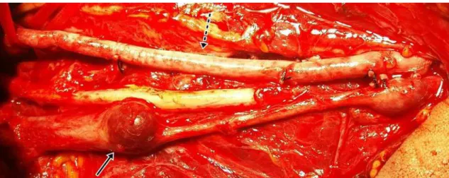 Figura 1. Reconstrução da artéria braquial esquerda com veia safena magna invertida (seta pontilhada) e aneurismas em veia  braquial, com destaque para o proximal (seta contínua).